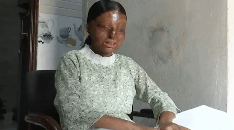 ಆಸಿಡ್ ದಾಳಿಯಲ್ಲಿ ದೃಷ್ಟಿ ಕಳೆದುಕೊಂಡ ಬಾಲಕಿ 12ನೇ ತರಗತಿ ಪರೀಕ್ಷೆಯಲ್ಲಿ ಶೇ.95.6 ಅಂಕ