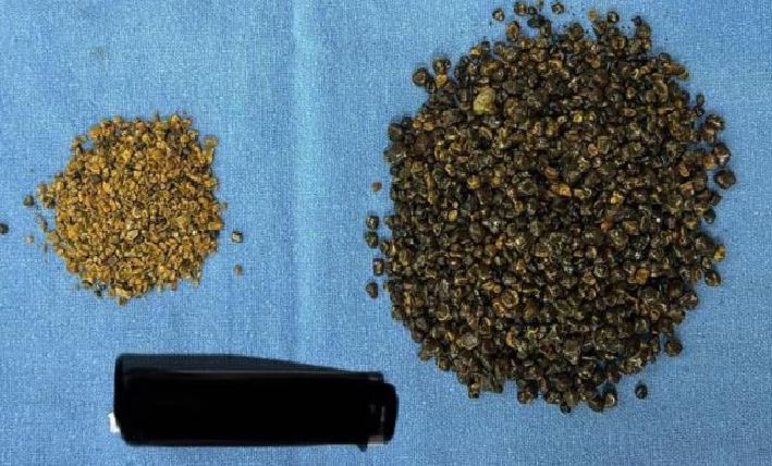 ವೃದ್ದನ ಹೊಟ್ಟೆಯಲ್ಲಿತ್ತು 8000 ಕಲ್ಲುಗಳು: 1 ಗಂಟೆ ಶಸ್ತ್ರಚಿಕಿತ್ಸೆ ನಡೆಸಿ ಜೀವ ಉಳಿಸಿದ ವೈದ್ಯರು